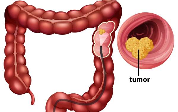 Colorectal Cancer Screening Market Size, Trends, and Forecast (2023-2033)