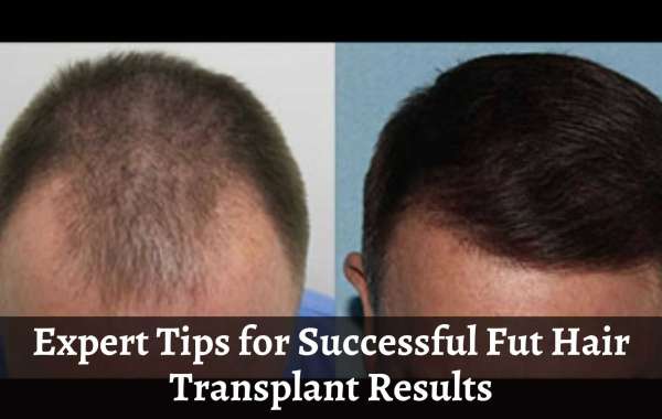 Expert Tips for Successful Fut Hair Transplant Results