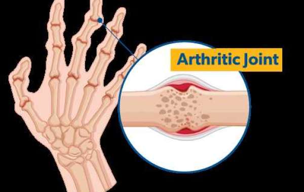 Unveiling the Secrets: What is the Average Lifespan of Arthritis?